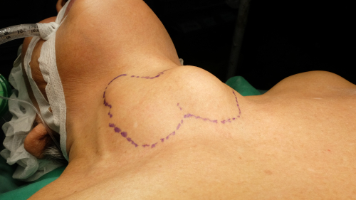 pós-operatório da tireoidectomia