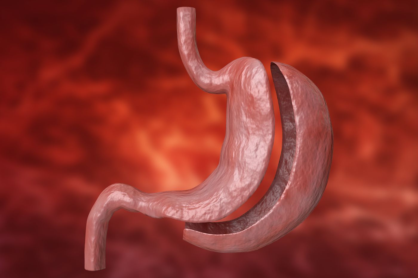 cirurgia bariátrica