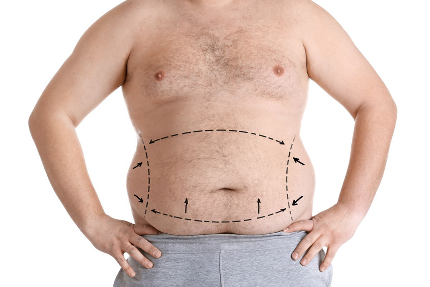cirurgia bariátrica