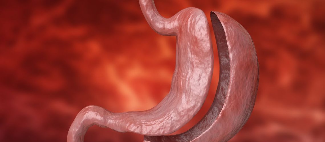 cirurgia bariátrica