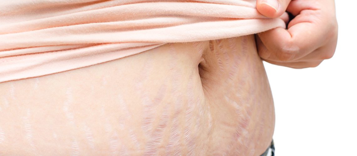 cirurgia de obesidade