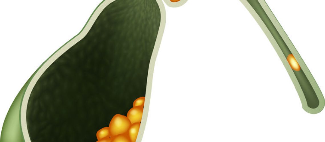 cálculo na vesícula