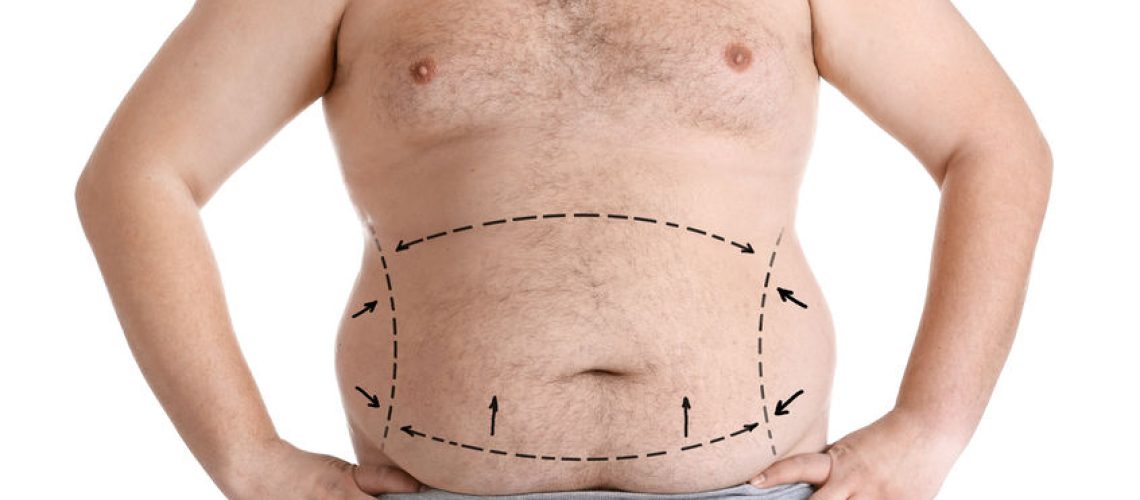 cirurgia bariátrica