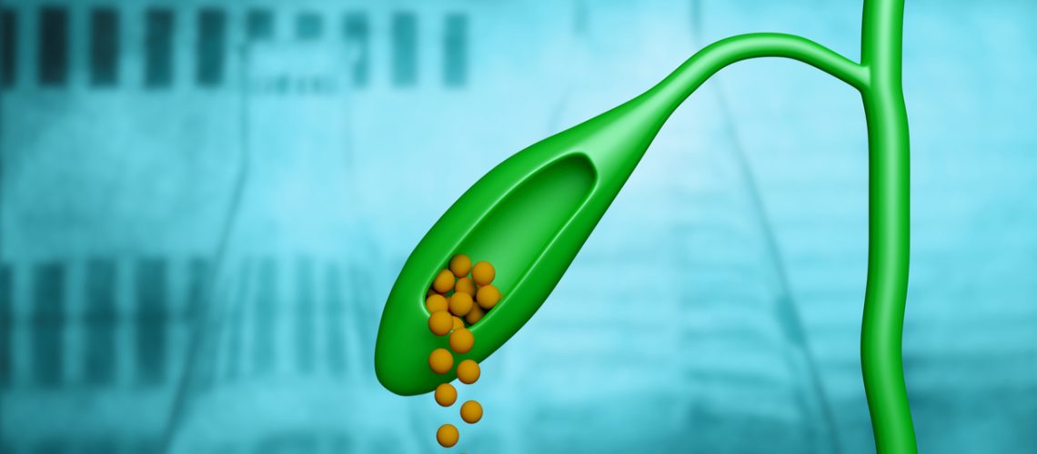 cálculo na vesícula