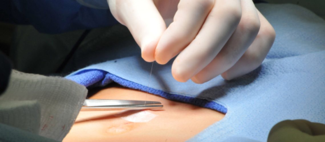 cirurgia de hérnia umbilical