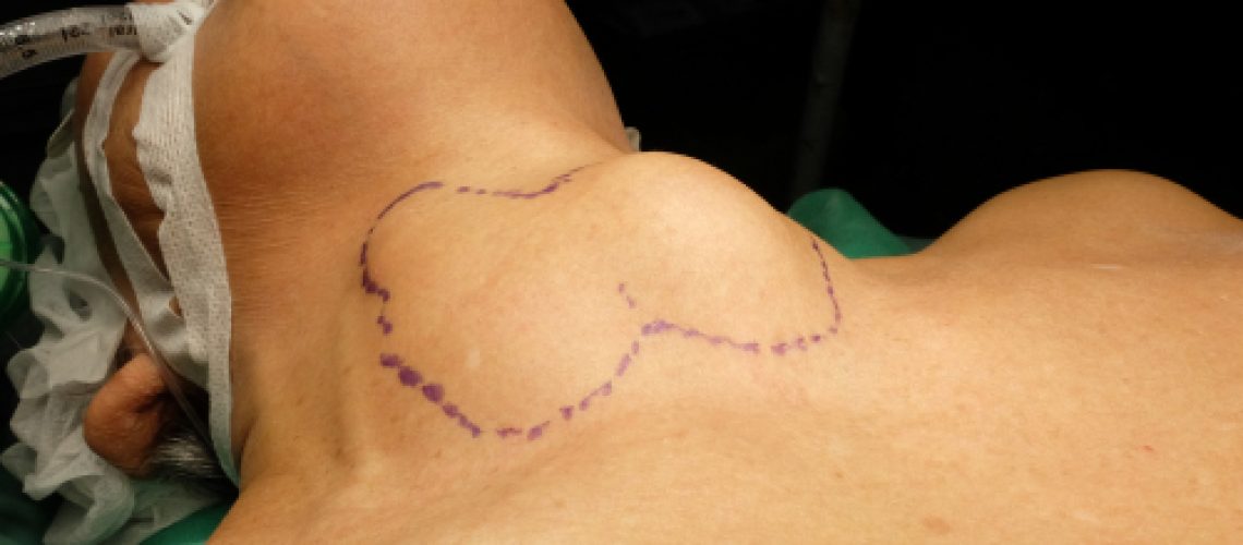 pós-operatório da tireoidectomia